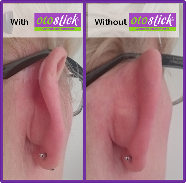  Otostick - 8 Count Cosmetic Discreet Protruding Ear