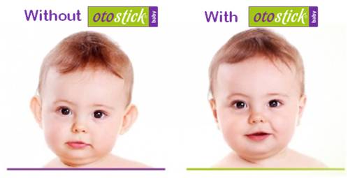 Otostick Baby Single Pack - Otostick USA | Aesthetic Ear Corrector